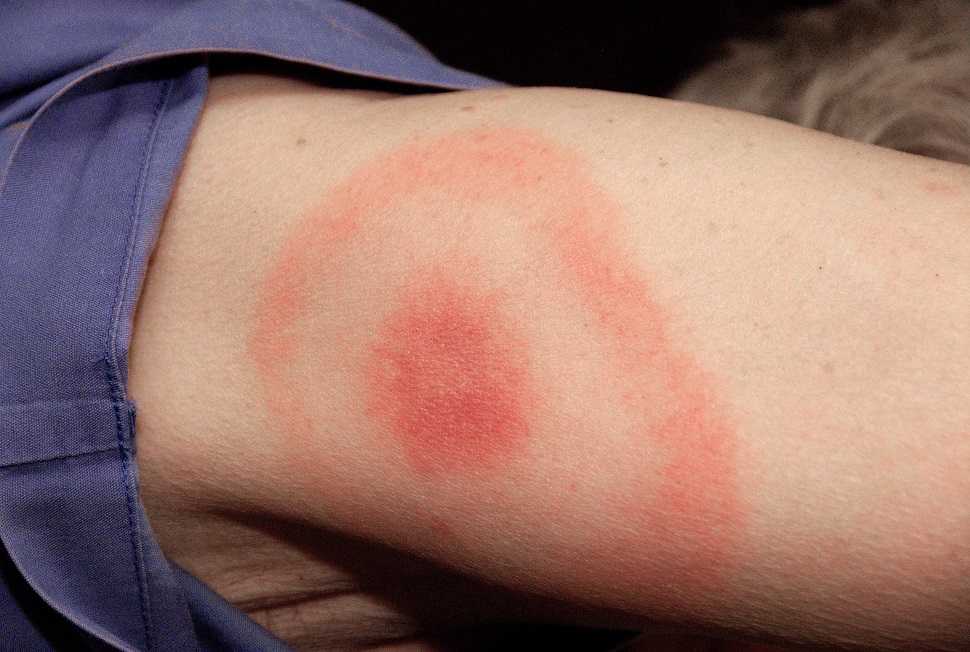 Conférence sur la maladie de Lyme – 28 mai 2025